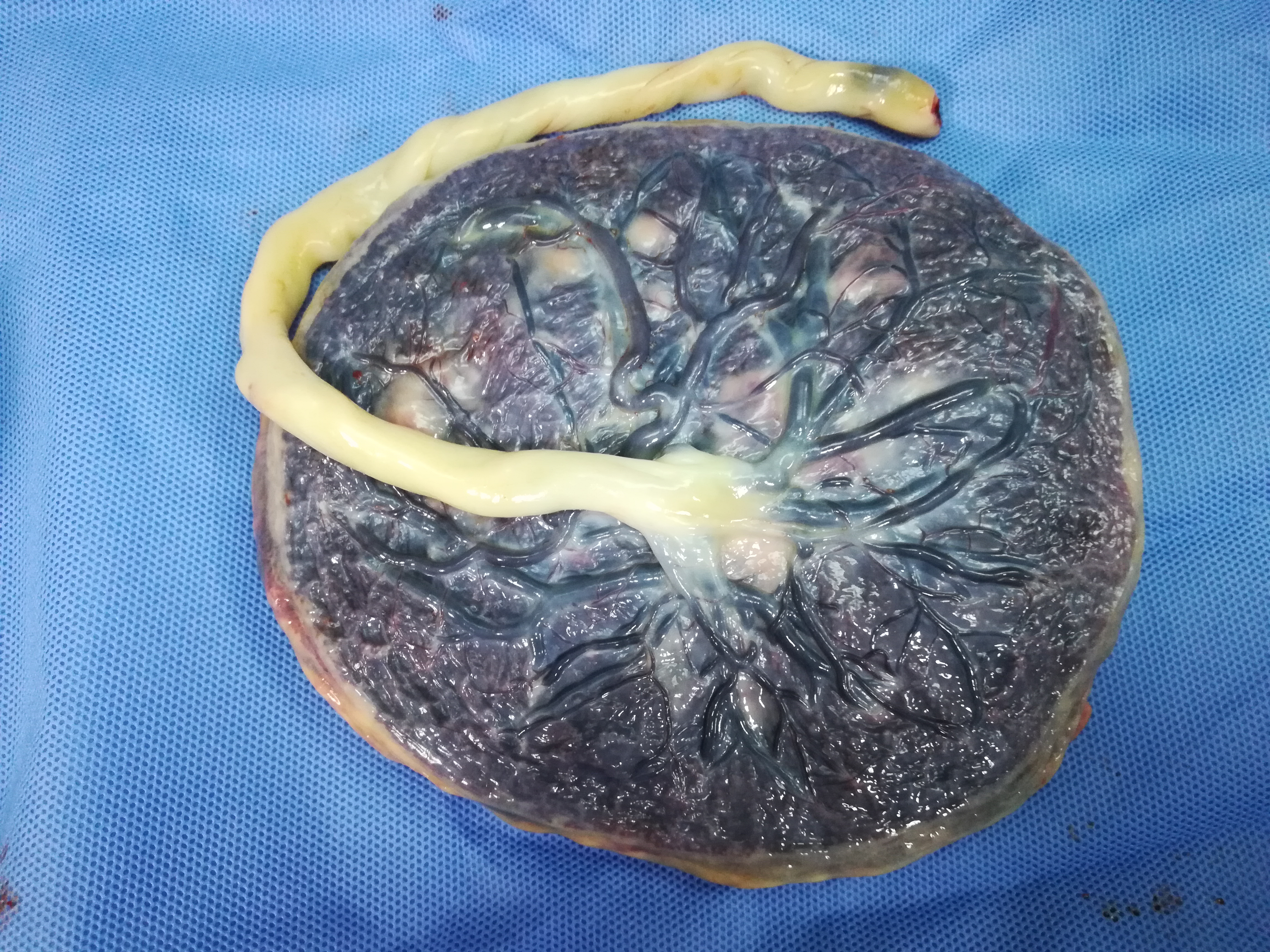 Pathology of the Placenta | Article | GLOWM